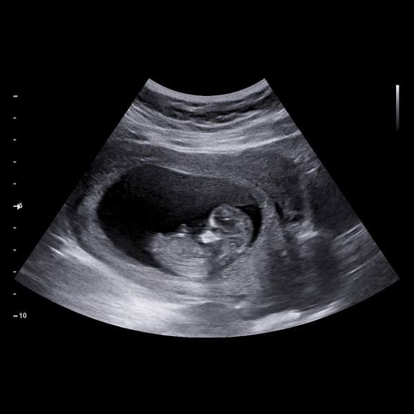 Ultrasound tele-reporting